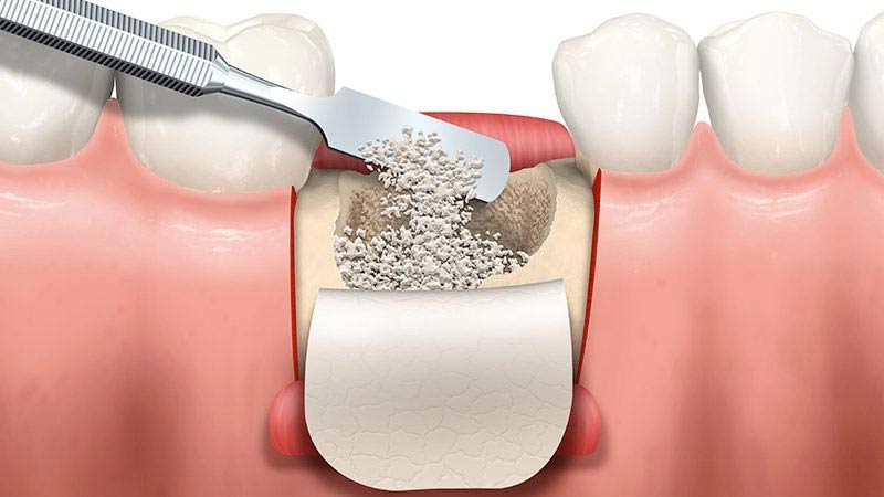 Innesto osseo dentale: guida completa a tempi, tecniche