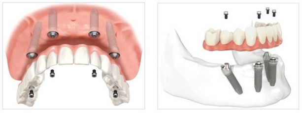 Sistema di impianti dentali ‘ALL ON 4’ NobelBiocare