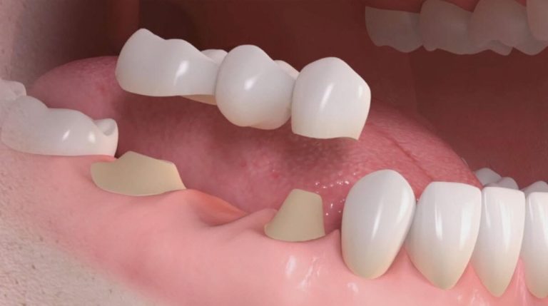 Impianti dentali in ceramica vs impianti in titanio