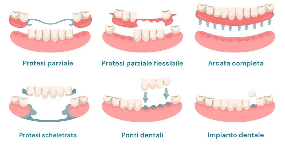 Cosa Sono le Protesi Dentali Fisse e Mobili - Budapest, Ungheria